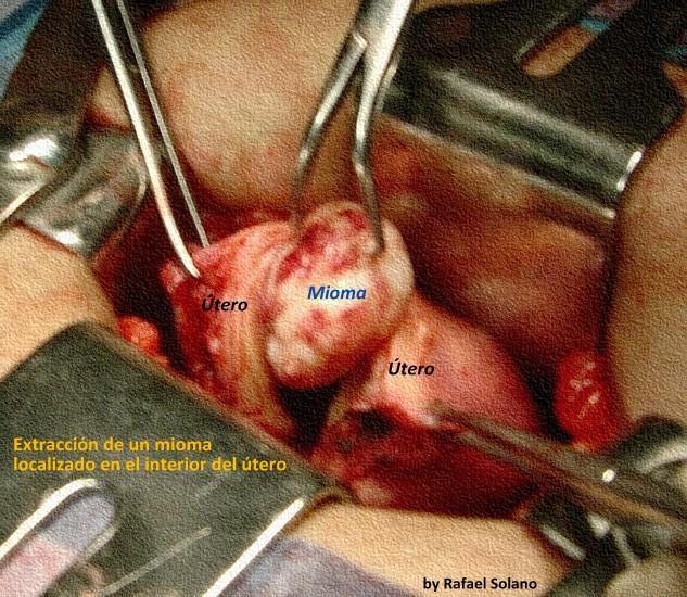  imagen cirugia de mioma, que es un mioma uterino